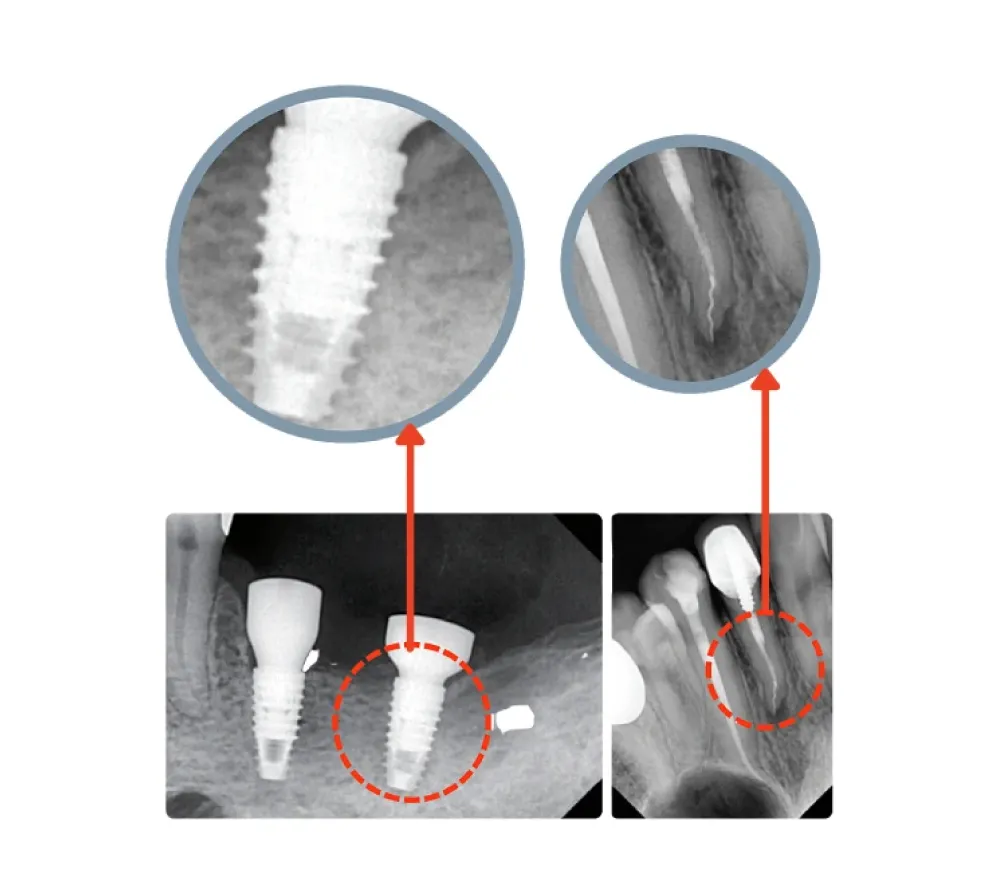 Vatech EzSensor HD цифровой интраоральный радиовизиограф 1.5   10