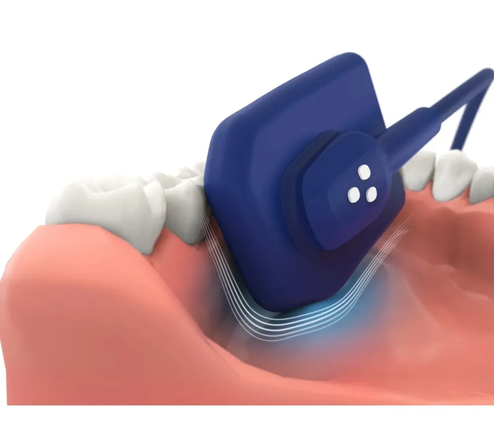 Vatech EzSensor Soft цифровой интраоральный радиовизиограф 1.5   11