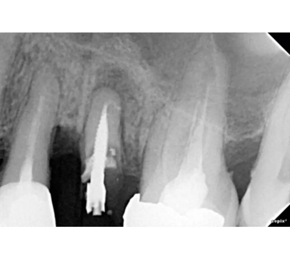 Acteon Group Sopro SOPIX 2 USB2 (размер 1) интраоральный радиовизиограф  4